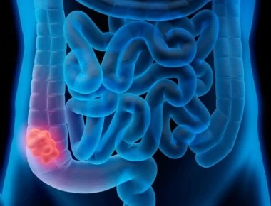 Καρκίνος του παχέος εντέρου: Πέντε σημάδια ότι πρέπει να πάτε στο γιατρό